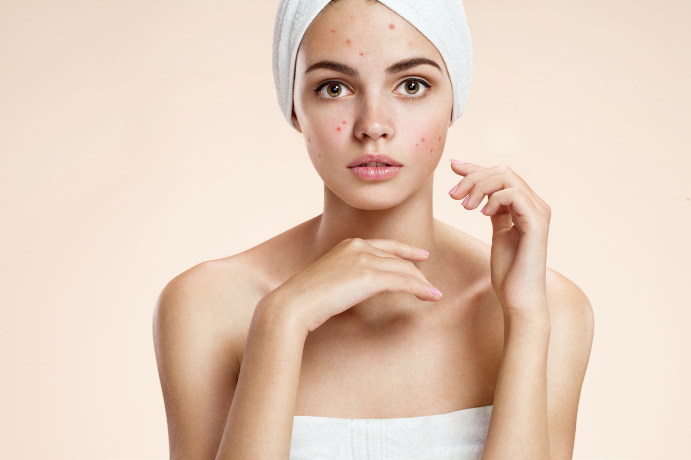 Acne | Facial Studio Magdalena in Chicago IL