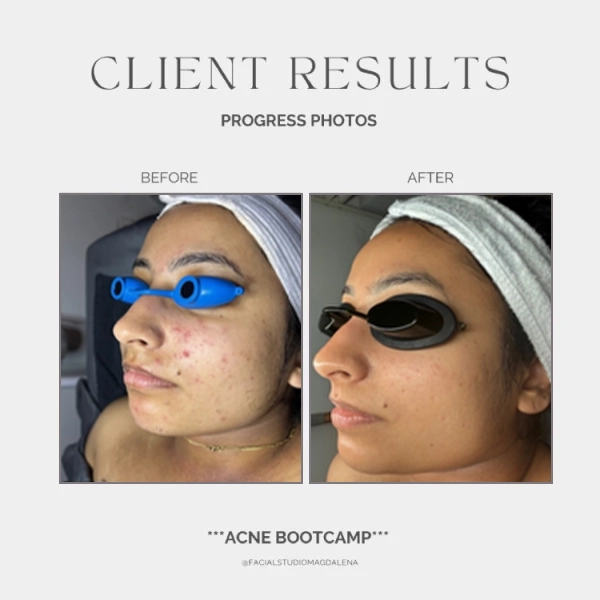 Acne Before and After (1)