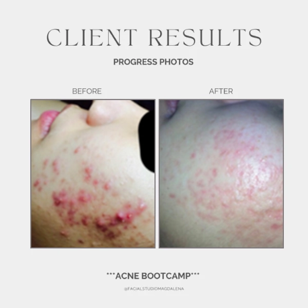 Acne Before and After (10)