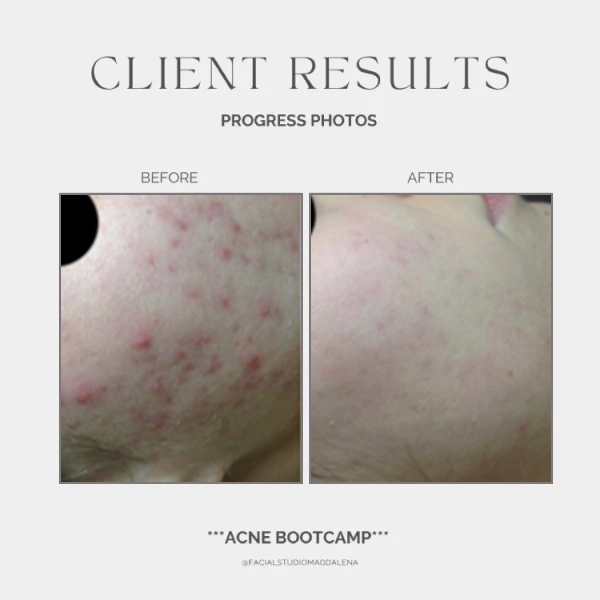Acne Before and After (11)