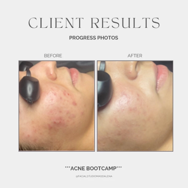 Acne Before and After (12)