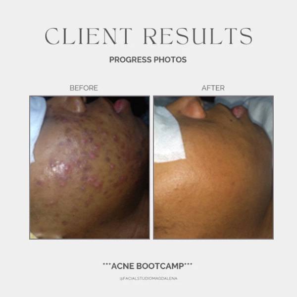 Acne Before and After (13)