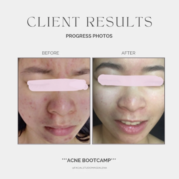 Acne Before and After (14)