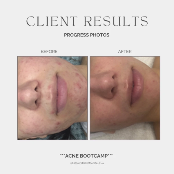 Acne Before and After (15)