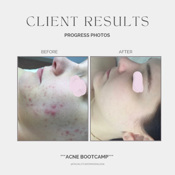 Acne Before and After (16)