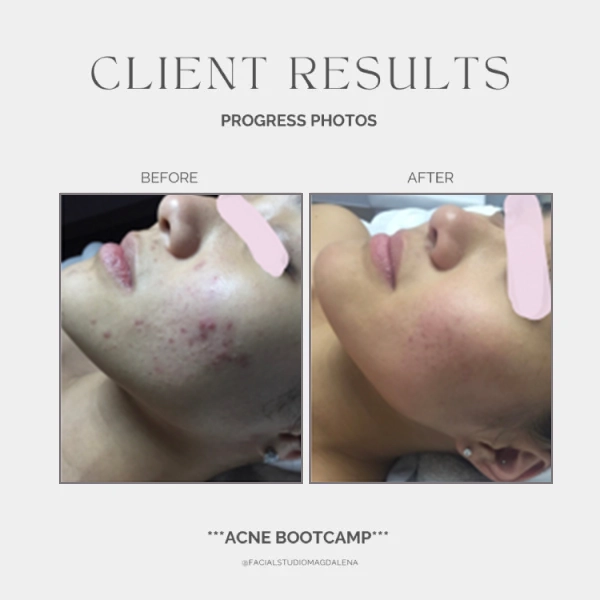 Acne Before and After (17)