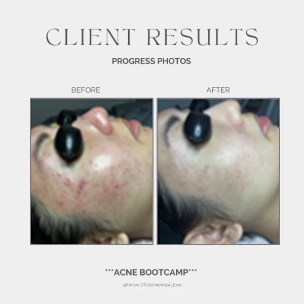 Acne Before and After (18)