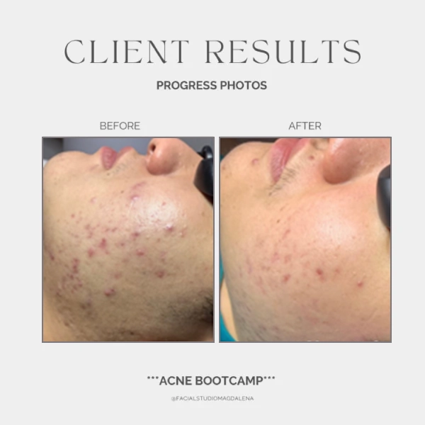 Acne Before and After (19)