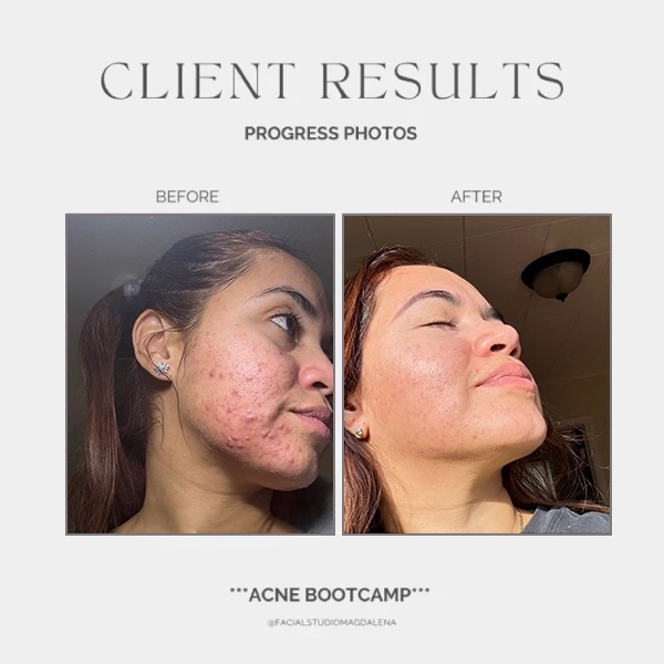 Acne Before and After (2)