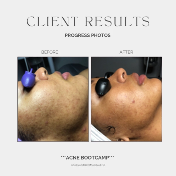 Acne Before and After (20)