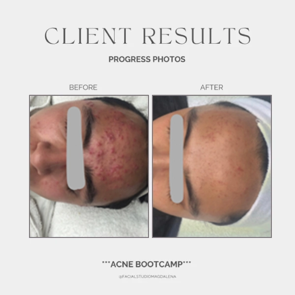 Acne Before and After (21)