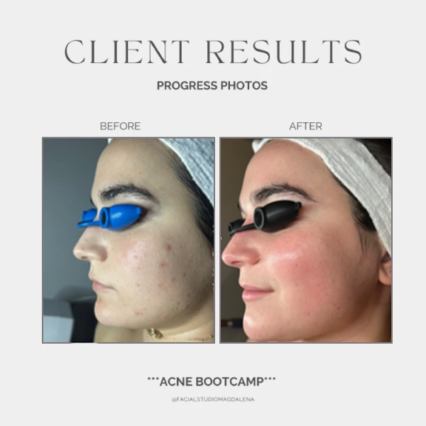 Acne Before and After (3)