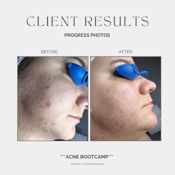 Acne Before and After (4)