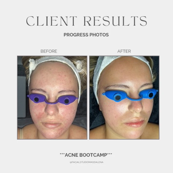 Acne Before and After (5)