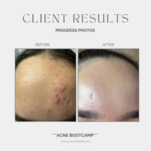 Acne Before and After (6)