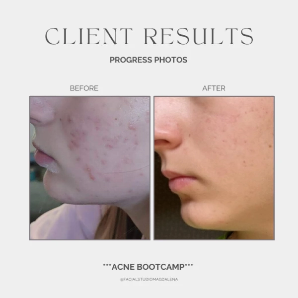 Acne Before and After (7)