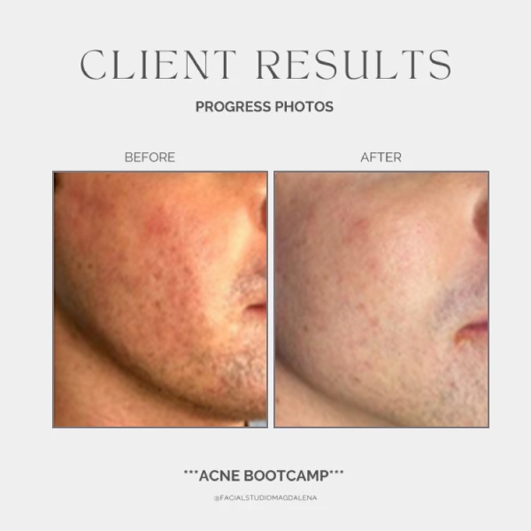 Acne Before and After (8)