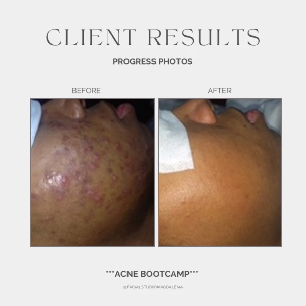 Acne Before and After (9)