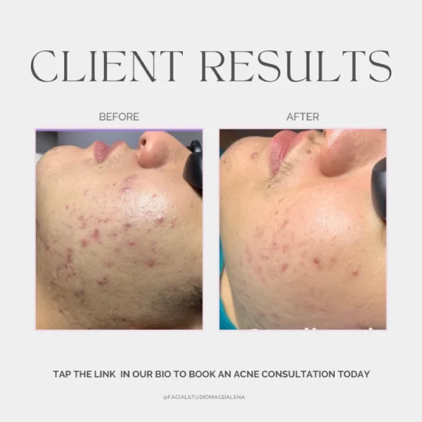 Acne Results | Facial Studio Magdalena in Chicago IL