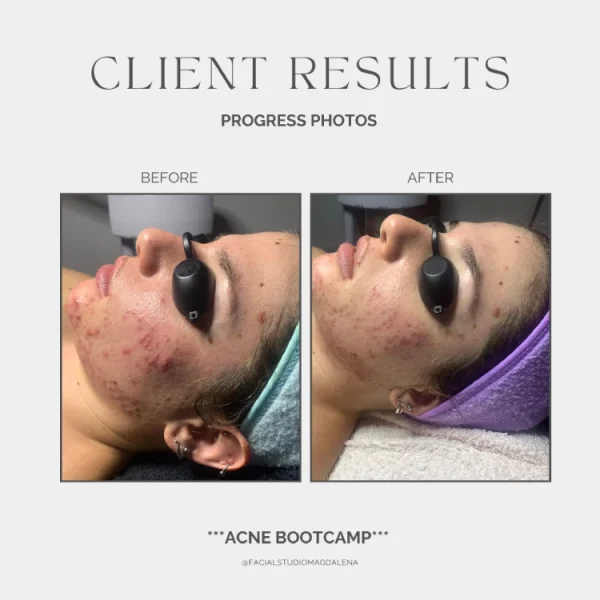 Before and After Acne Result | Facial Studio Magdalena in Chicago IL