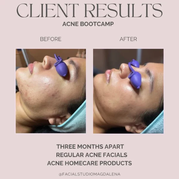 Client Results Acne Bootcamp | Facial Studio Magdalena in Chicago IL