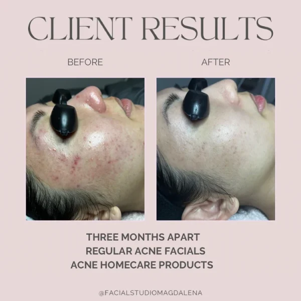 Client Results 3 Months | Facial Studio Magdalena in Chicago IL