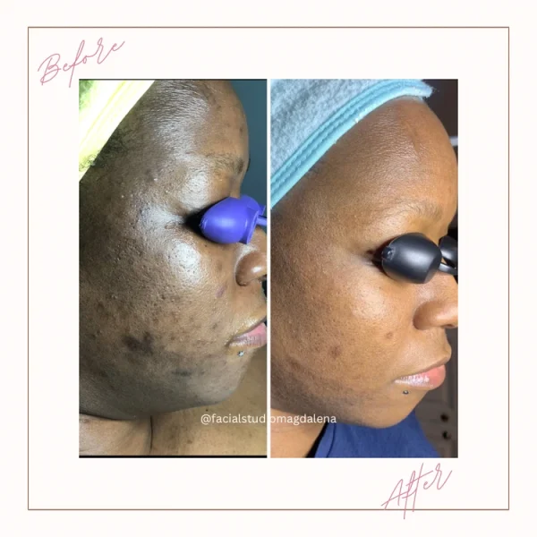 Before and After Client Result | Facial Studio Magdalena in Chicago IL