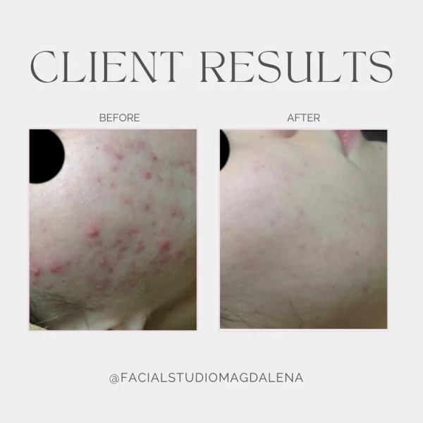 Acne Results | Facial Studio Magdalena in Chicago IL