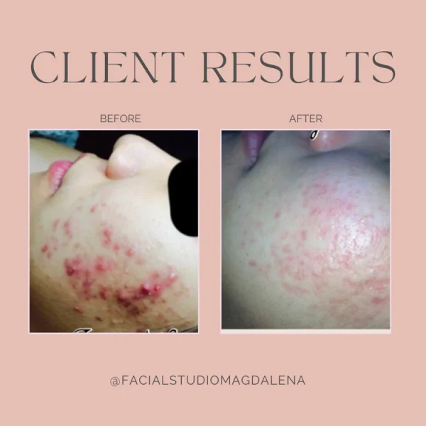 Client Results Facial Studio Magdalena in Chicago IL