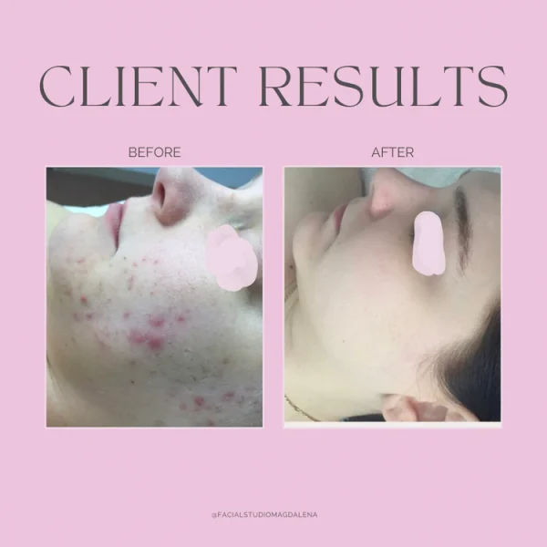 Client Results Acne | Facial Studio Magdalena in Chicago IL