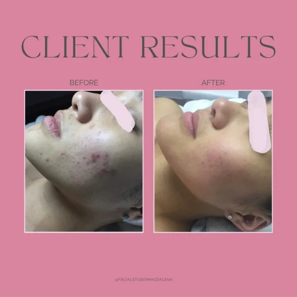 Acne Result at Facial Studio Magdalena in Chicago IL